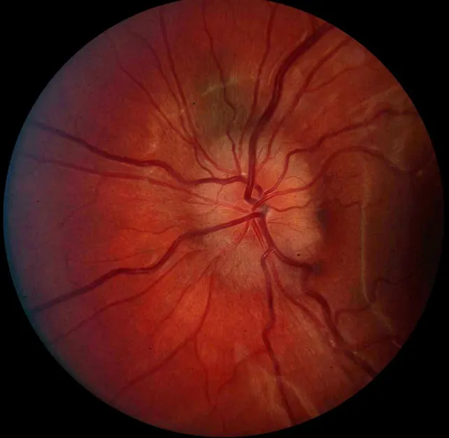 Edema de Papila